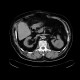 Renal carcinoma, treatment with RFA, follow-up: CT - Computed tomography